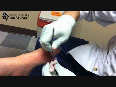 Gout Lesion Drainage - Foot
