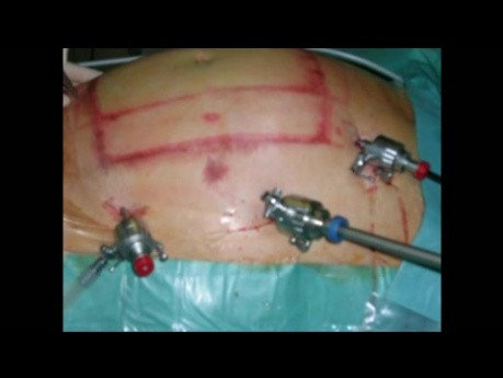 Simultaneous Laparoscopic Repair of Spiegelian and Umbilical Hernias Using Intraperitoneal Mesh