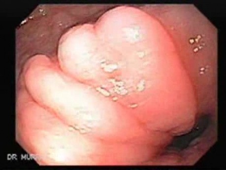 Intestinal Metaplasia - Endoscopy (3 of 5)