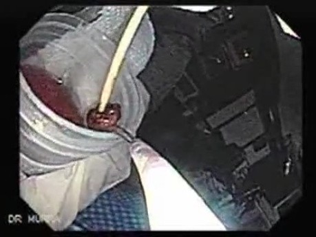 Endoscopic Resection of Giant Tubulo-Villous of the rectum (20 of 35)