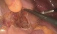 Laparoscopic Low Anterior Resection