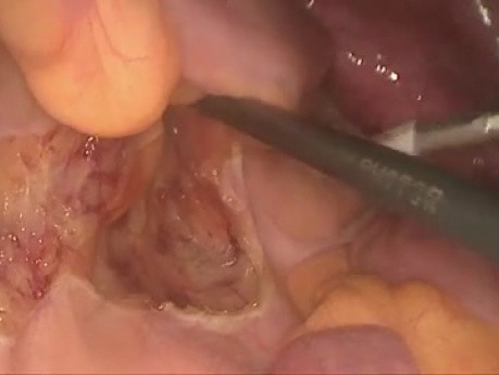 Laparoscopic Low Anterior Resection