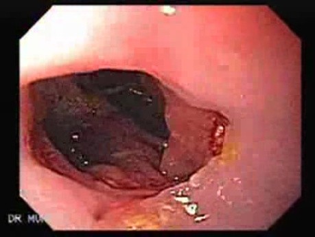 Esophageal Stricture After Total Gastrectomy And Chemoradiation - Effects Of Baloon Dilation