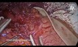 Laparoscopic Heller Myotomy and Dor Fundoplication