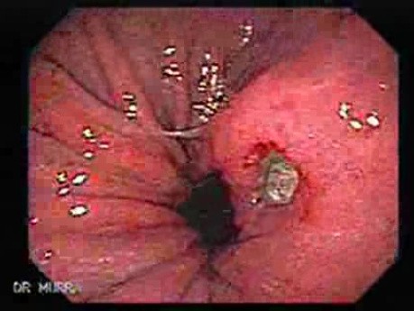 Hourglass Stomach - 62 Years-Old Female