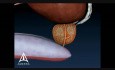 Enlarged Prostate - 3D Medical Animation