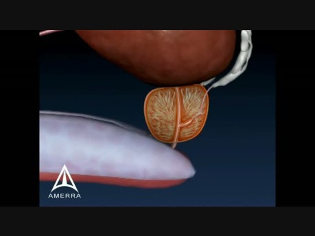 Enlarged Prostate - 3D Medical Animation