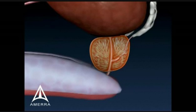Enlarged Prostate - 3D Medical Animation • Video • 