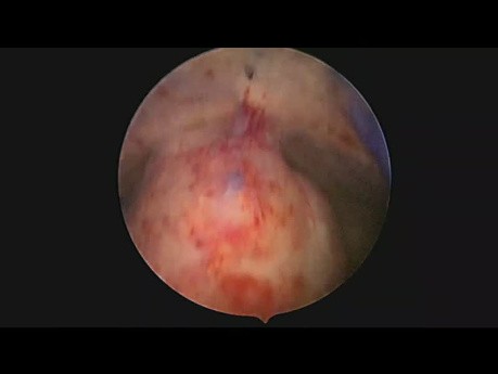 4 Cm Size Submucose Fibroid Excision With Resectoscope
