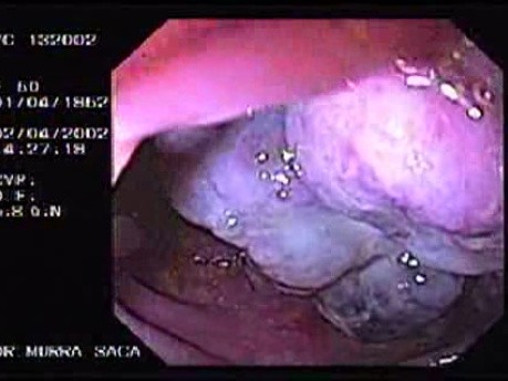 Metastasis Of Renal Carcinoma To The Ascending Colon (1 of 11)