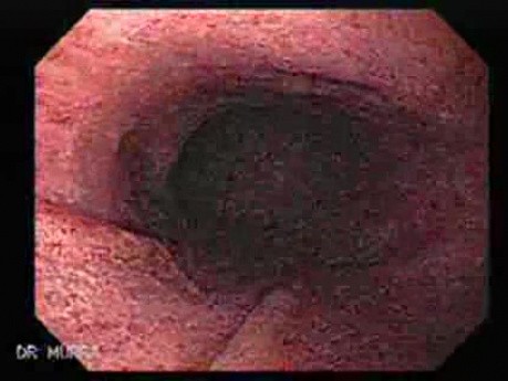 Linitis Plastica - Endoscopy (1 of3)