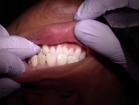Temporary Implant Crown - Eliminate Excursive Contacts