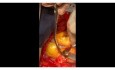 Complete Review of Pulmonary artery Embolectomy 