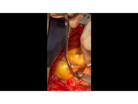 Complete Review of Pulmonary artery Embolectomy 