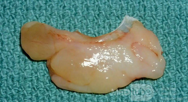 Polypoid Degeneration of Lateral Surface of Concha Bullosa