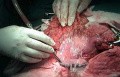 Plastic Linitis with bilateral Krukenberg´s tumor (7 of 13)