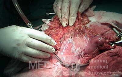 Plastic Linitis with bilateral Krukenberg´s tumor (7 of 13)