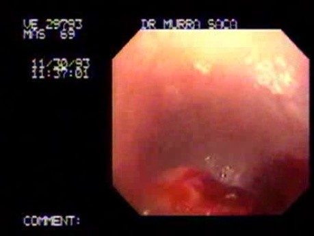 Squamous Cell Carcinoma of the Cardias - Presentation of the Tumor