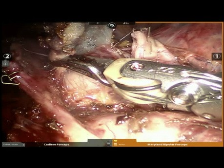 Right Upper Lobectomy
