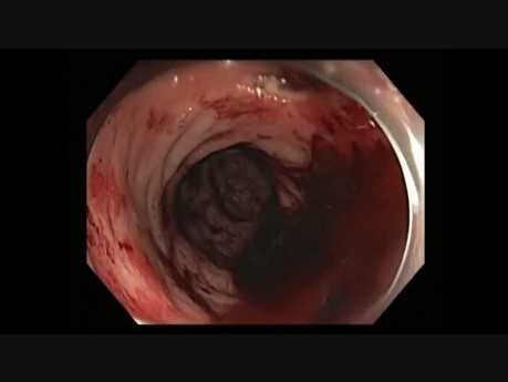 Colonoscopy - Rectum - Radiation Telangectasia with an Ulcer