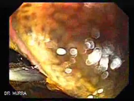 Barrett Esophagus - endoscopic view  (7 of 9)