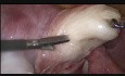 Laparoscopic Myomectomy in Case of Posterior Wall Fibroid