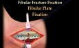 Ankle Fractures and Repair - Video Lecture