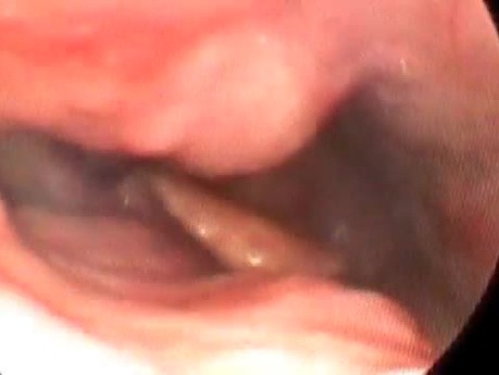 Endoscopic Look at Aberrant Carotid Artery
