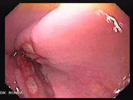 Gastrointestinal Stromal Tumors - Assessment of the Mucosa