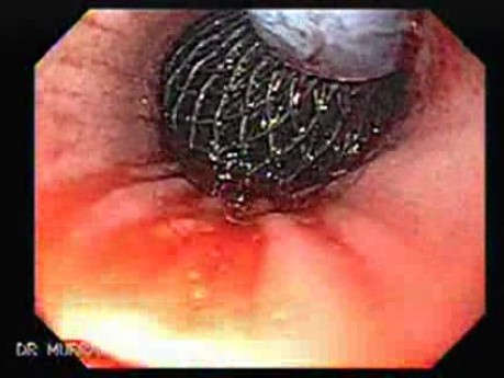 Failed Placement Of The Esophageal Stent