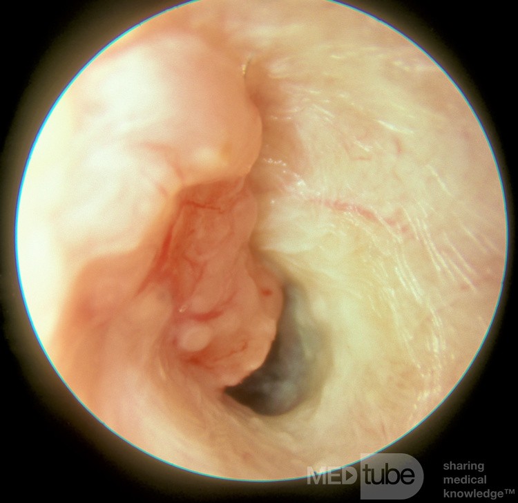 Ceruminoma