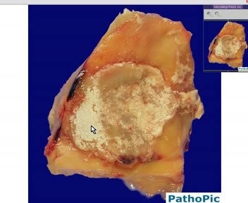 Interphalangeal Joint Of Toe - Gout