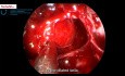 TachoSil® Application to Provide Additional Sealing of the Dura Mater During Endoscopic Pituitary Adenoma Resection Surgery