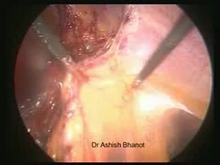 Laparoscopic Incisional Hernia Repair