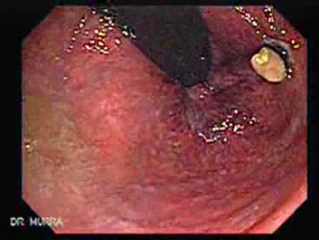 Status Post Rubber Band Ligation for Internal Hemorrhoids (4 of 7)