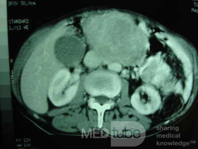 Gastric Ulcer with Gastrocolic fistula due to a Zollinger-
 Ellison Syndrome (27 of 33)