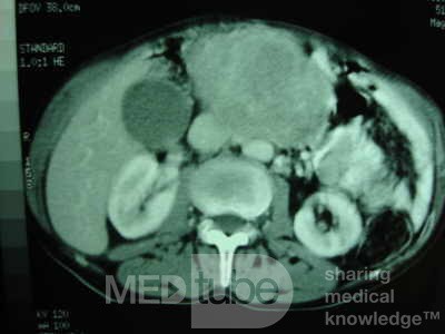 Gastric Ulcer with Gastrocolic fistula due to a Zollinger-
 Ellison Syndrome (27 of 33)