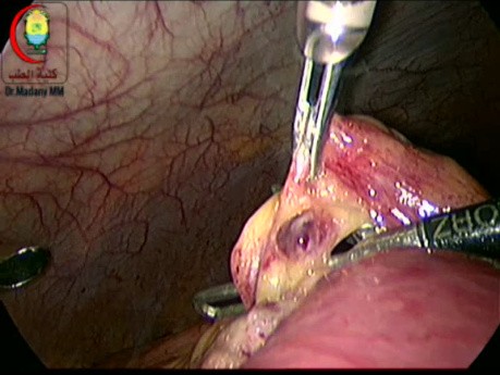 Adhesive Intestinal Obstruction