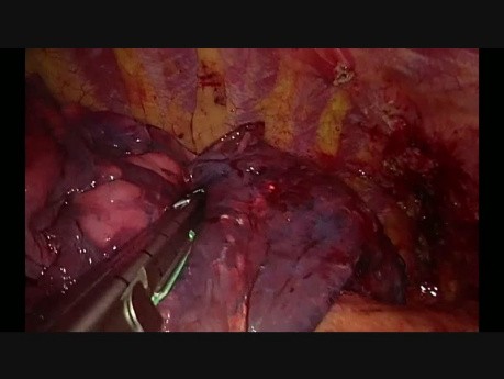 Subxiphoid Uniportal RUL in a Big Tumor with Tracheal Bronchus