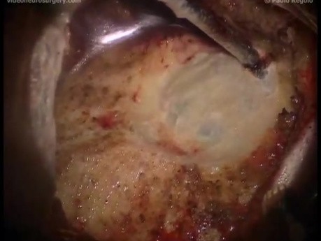 PCF Subdural Hematoma - Suboccipital Approach