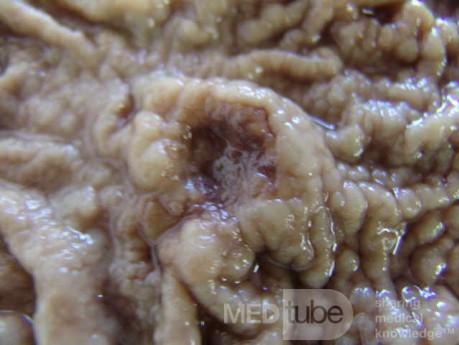Adenocarcinoma of the Antrum and incisura angularis (7 of 12)