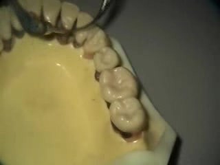 Ultrasonic Endoscopic  Debridement Simulation (LR)