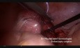 How to Over Rule the Indications of Laparoscopic Myomectomy