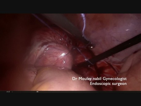 How to Over Rule the Indications of Laparoscopic Myomectomy