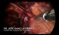 Laparoscopic Repair of Recurrent Inguinal Hernia. TAPP Dexter.
