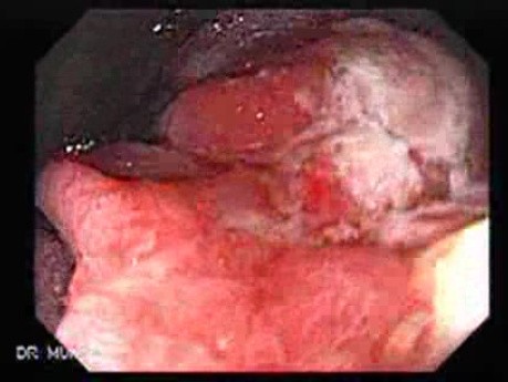 Multiple Adenomatous Polyps Of The Rectum (18 of 37)