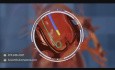 3D Medical Animation - Deployment of Artificial Heart Valve