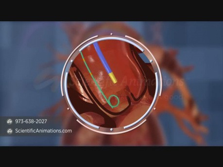 3D Medical Animation - Deployment of Artificial Heart Valve