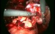 Surgery of Endometriosis - Laparoscopic Method