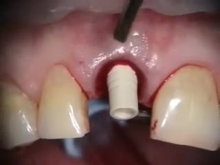 Failing Upper Central, Immediate Implant And Provisional